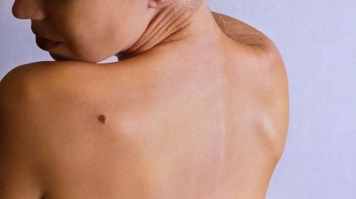 Climate change is shifting areas of skin disease concern 